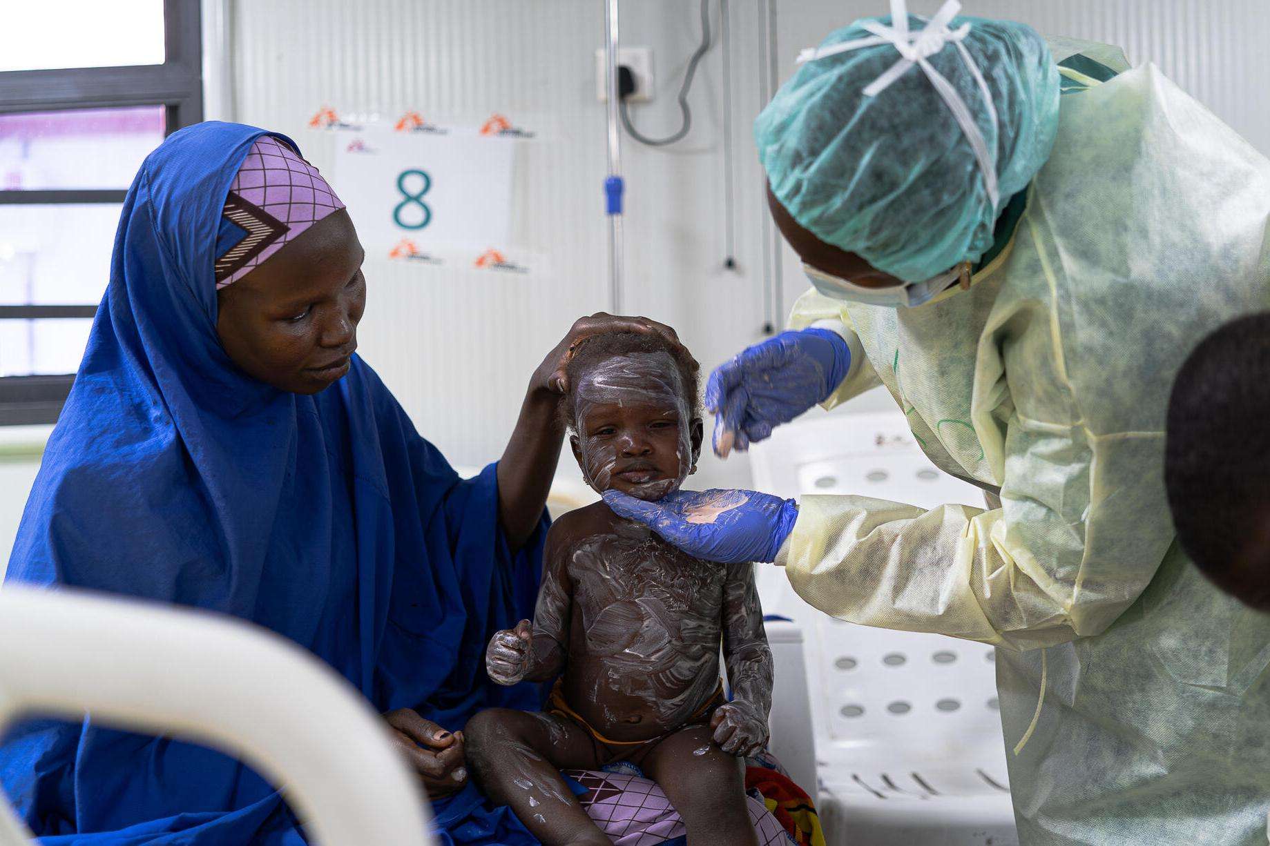 A young measles patient is treated with zinc ointment at the MSF Nilefa Kiji facility in Maiduguri, Nigeria.