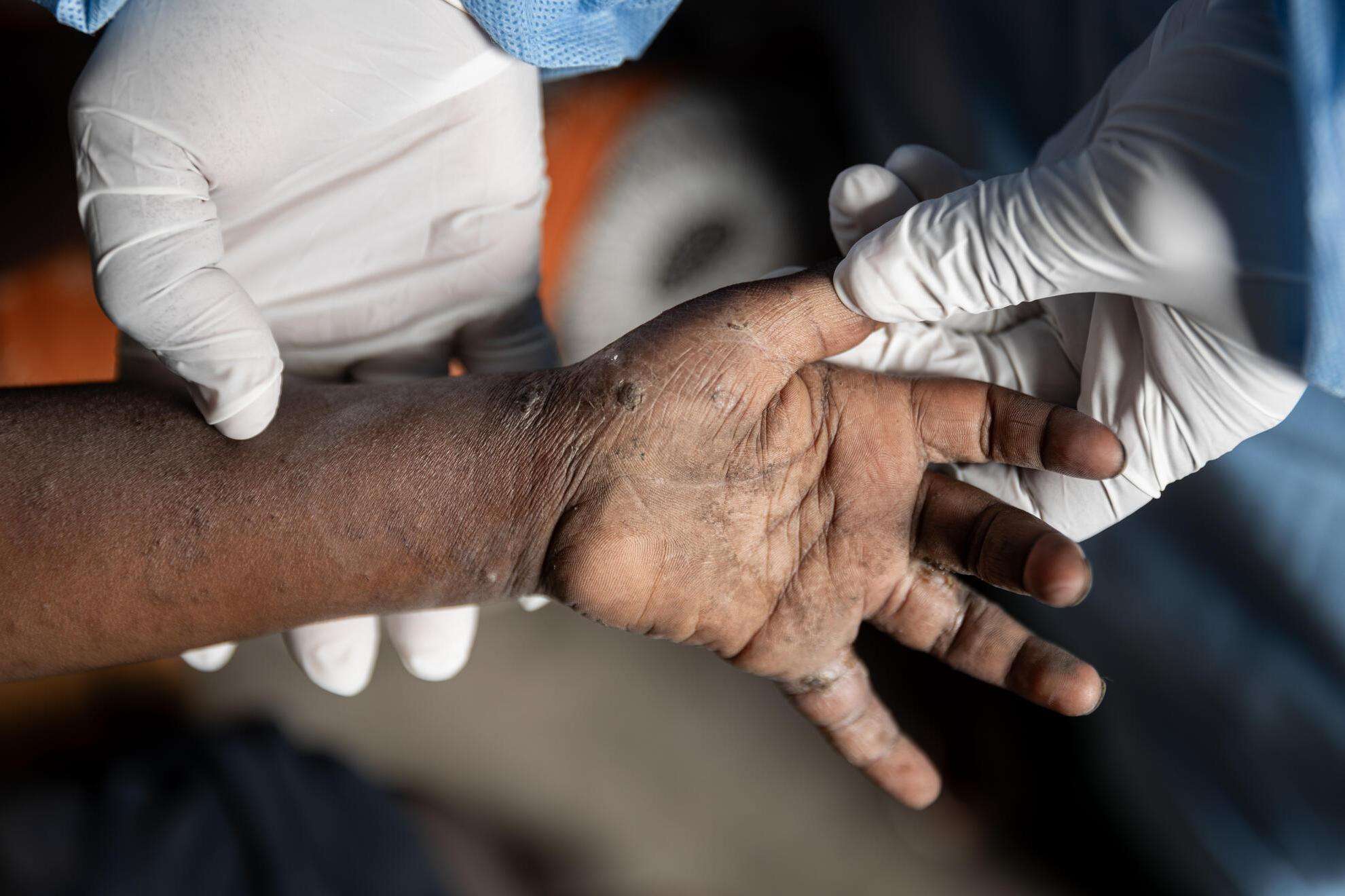 A hand with mpox, formerly known as monkeypox, in DR Congo.