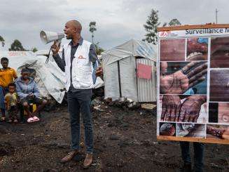 Mpox Cases Amidst Displacement Sites Near Goma