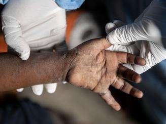 A hand with mpox, formerly known as monkeypox, in DR Congo.