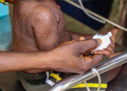 A child with measles in DRC. 