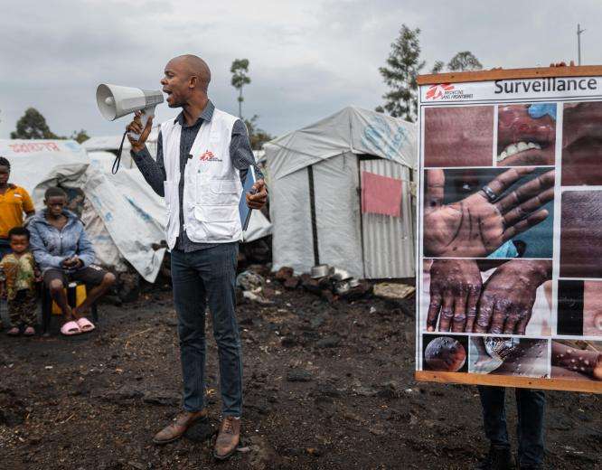 Mpox Cases Amidst Displacement Sites Near Goma